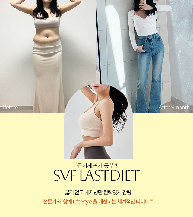 Body Lift – Abdomen